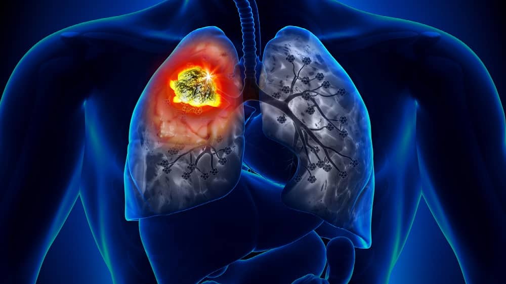 Câncer de pulmão entenda as causas, sinais e tratamentos da doença 1