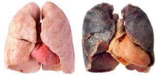 Câncer de pulmão entenda as causas, sinais e tratamentos da doença 2