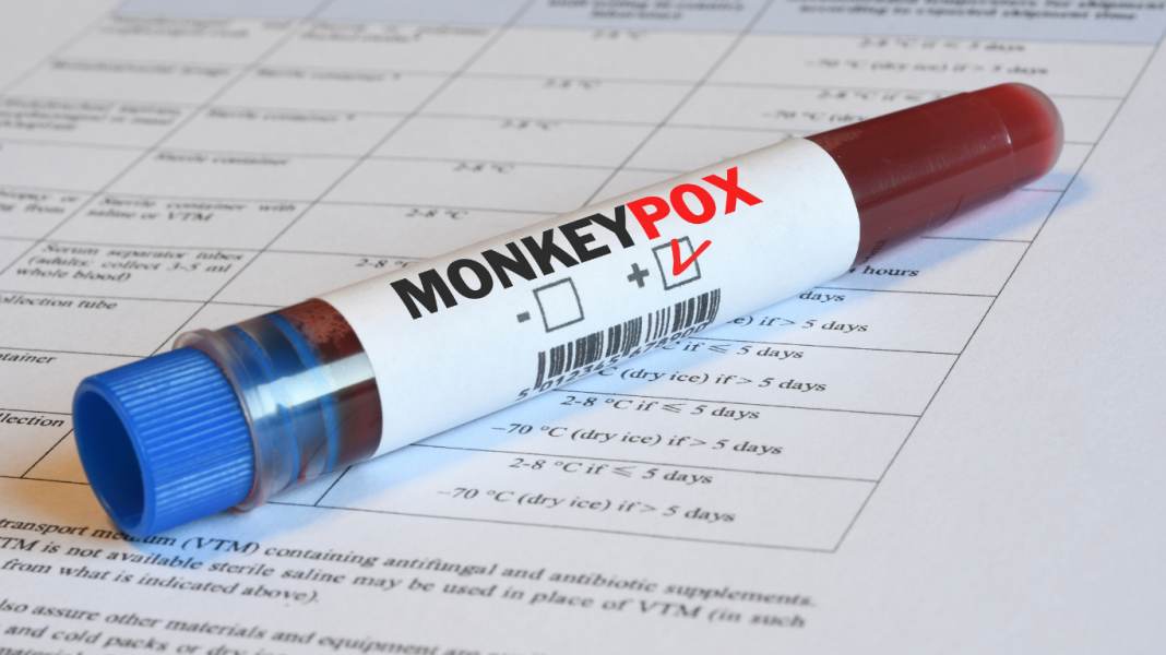 Na região: Caso de MPOX é confirmado em Araraquara